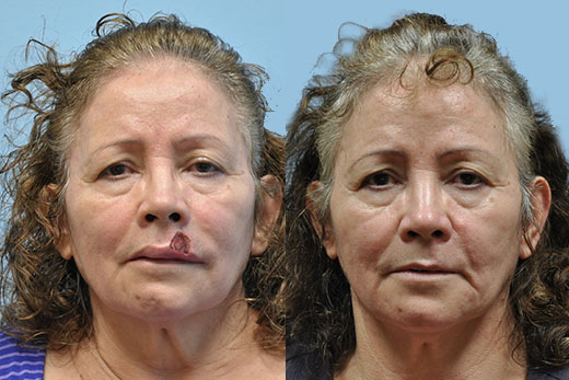 Mohs Reconstruction before and after photo by Midwest Facial Plastic Surgery in Minnesota