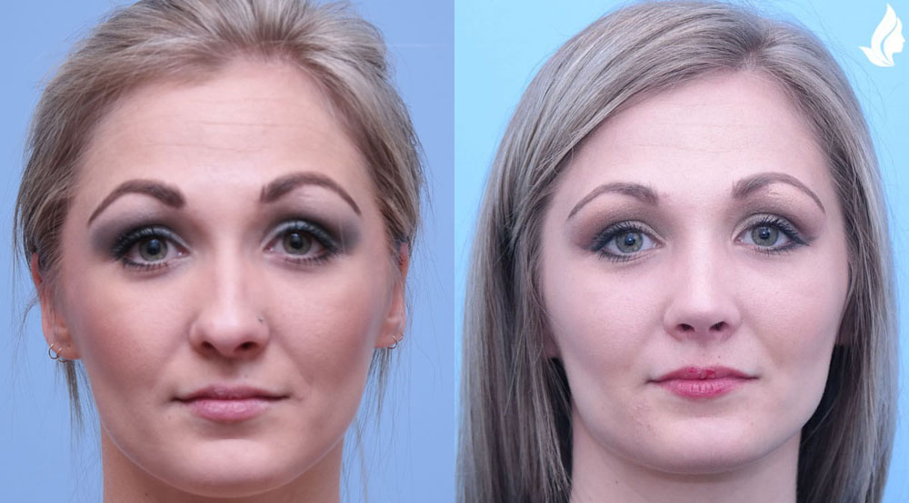 Rhinoplasty before and after photo by Midwest Facial Plastic Surgery in Minnesota