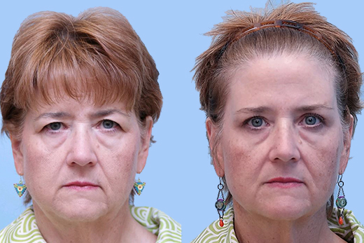 Eyelid Surgery before and after photo by Midwest Facial Plastic Surgery in Minnesota