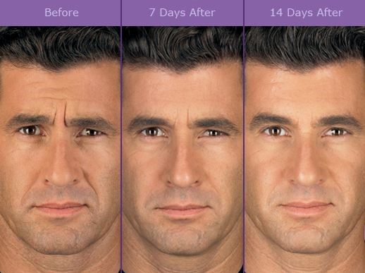 Botox for men results
