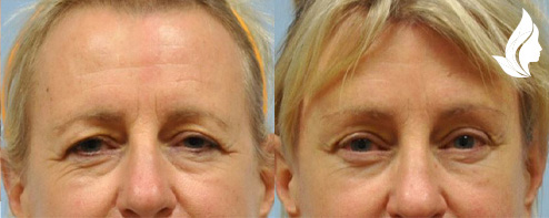 Brow/Forehead Lift before and after photo by Midwest Facial Plastic Surgery in Minnesota