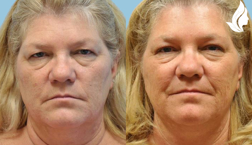 Brow/Forehead Lift before and after photo by Midwest Facial Plastic Surgery in Minnesota