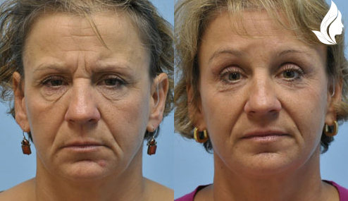 Brow/Forehead Lift before and after photo by Midwest Facial Plastic Surgery in Minnesota