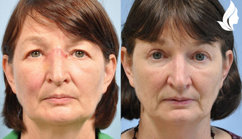 Brow/Forehead Lift before and after photo by Midwest Facial Plastic Surgery in Minnesota