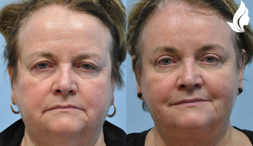 Brow/Forehead Lift before and after photo by Midwest Facial Plastic Surgery in Minnesota