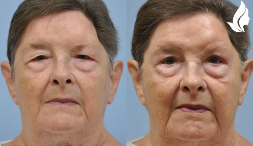 Brow/Forehead Lift before and after photo by Midwest Facial Plastic Surgery in Minnesota