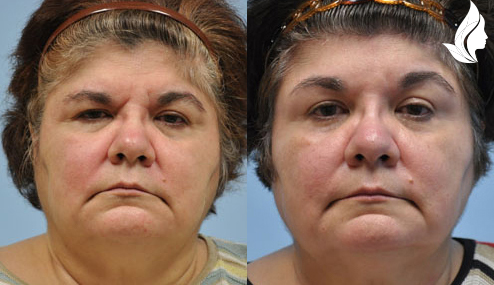 Brow/Forehead Lift before and after photo by Midwest Facial Plastic Surgery in Minnesota