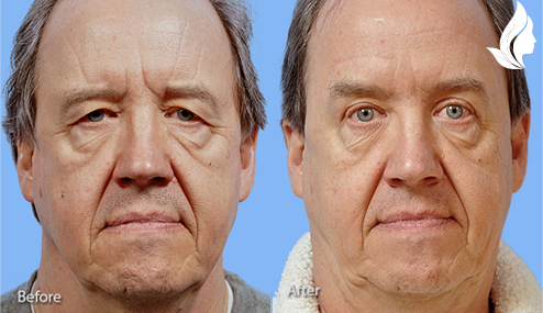 Brow/Forehead Lift before and after photo by Midwest Facial Plastic Surgery in Minnesota