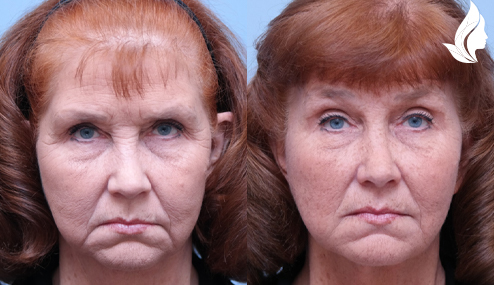 Brow/Forehead Lift before and after photo by Midwest Facial Plastic Surgery in Minnesota