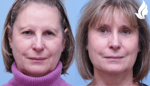 Brow/Forehead Lift before and after photo by Midwest Facial Plastic Surgery in Minnesota