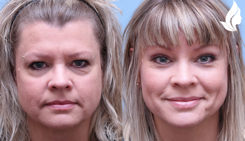 Brow/Forehead Lift before and after photo by Midwest Facial Plastic Surgery in Minnesota