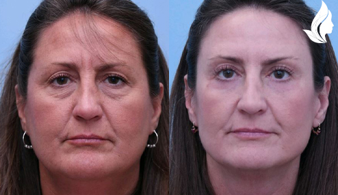 Brow/Forehead Lift before and after photo by Midwest Facial Plastic Surgery in Minnesota