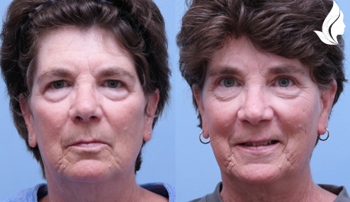 Brow/Forehead Lift before and after photo by Midwest Facial Plastic Surgery in Minnesota