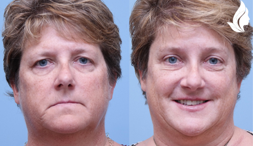 Brow/Forehead Lift before and after photo by Midwest Facial Plastic Surgery in Minnesota