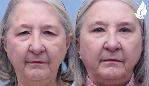 Brow/Forehead Lift before and after photo by Midwest Facial Plastic Surgery in Minnesota