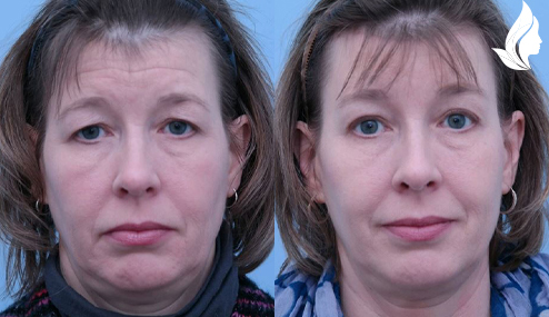 Brow/Forehead Lift before and after photo by Midwest Facial Plastic Surgery in Minnesota