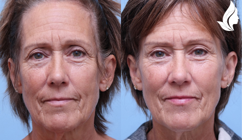 Brow/Forehead Lift before and after photo by Midwest Facial Plastic Surgery in Minnesota