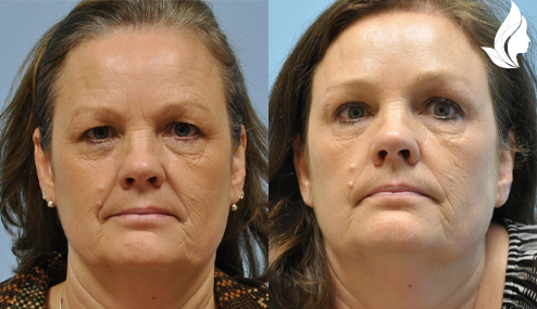 Brow/Forehead Lift before and after photo by Midwest Facial Plastic Surgery in Minnesota