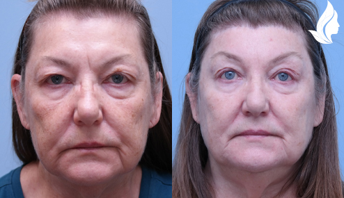 Brow/Forehead Lift before and after photo by Midwest Facial Plastic Surgery in Minnesota