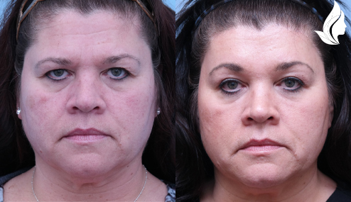 Brow/Forehead Lift before and after photo by Midwest Facial Plastic Surgery in Minnesota