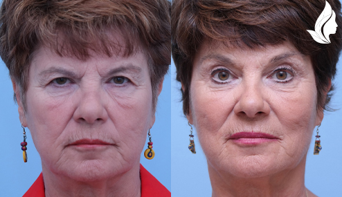 Brow/Forehead Lift before and after photo by Midwest Facial Plastic Surgery in Minnesota