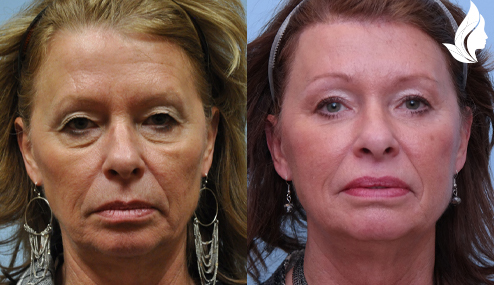 Brow/Forehead Lift before and after photo by Midwest Facial Plastic Surgery in Minnesota
