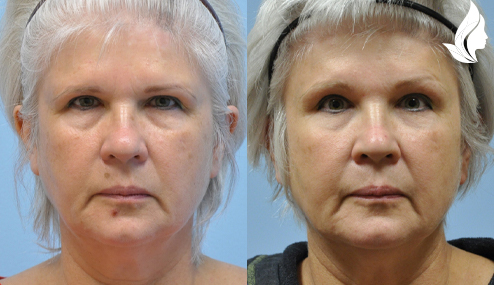 Brow/Forehead Lift before and after photo by Midwest Facial Plastic Surgery in Minnesota