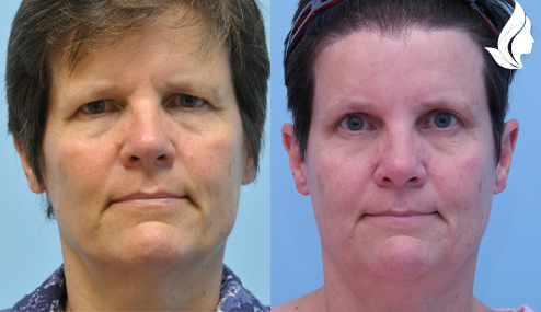 Brow/Forehead Lift before and after photo by Midwest Facial Plastic Surgery in Minnesota