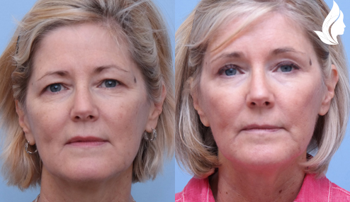 Brow/Forehead Lift before and after photo by Midwest Facial Plastic Surgery in Minnesota