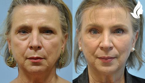 Brow/Forehead Lift before and after photo by Midwest Facial Plastic Surgery in Minnesota