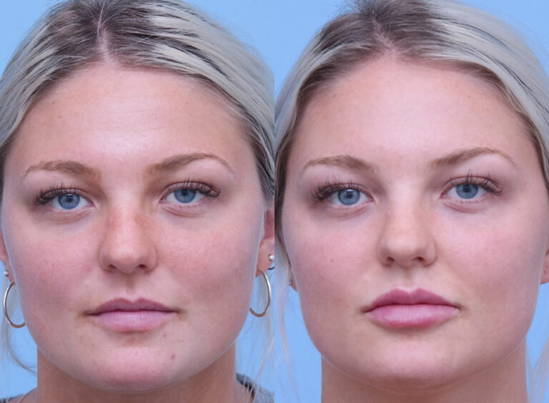 Lip Augmentation before and after photo by Midwest Facial Plastic Surgery in Minnesota