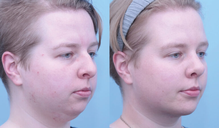 Facial Implants Chin Augmentation before and after photo by Midwest Facial Plastic Surgery in Minnesota