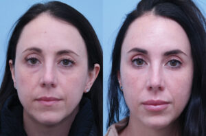 Injectable Fillers before and after photo by Midwest Facial Plastic Surgery in Minnesota