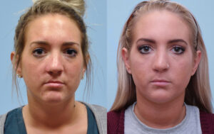 Injectable Fillers before and after photo by Midwest Facial Plastic Surgery in Minnesota