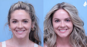 Injectable Fillers before and after photo by Midwest Facial Plastic Surgery in Minnesota