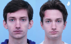 Otoplasty (Ear Reconstruction) before and after photo by Midwest Facial Plastic Surgery in Minnesota