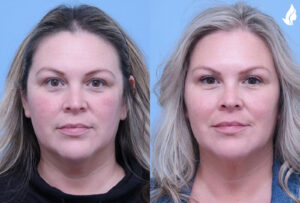 Injectable Fillers before and after photo by Midwest Facial Plastic Surgery in Minnesota