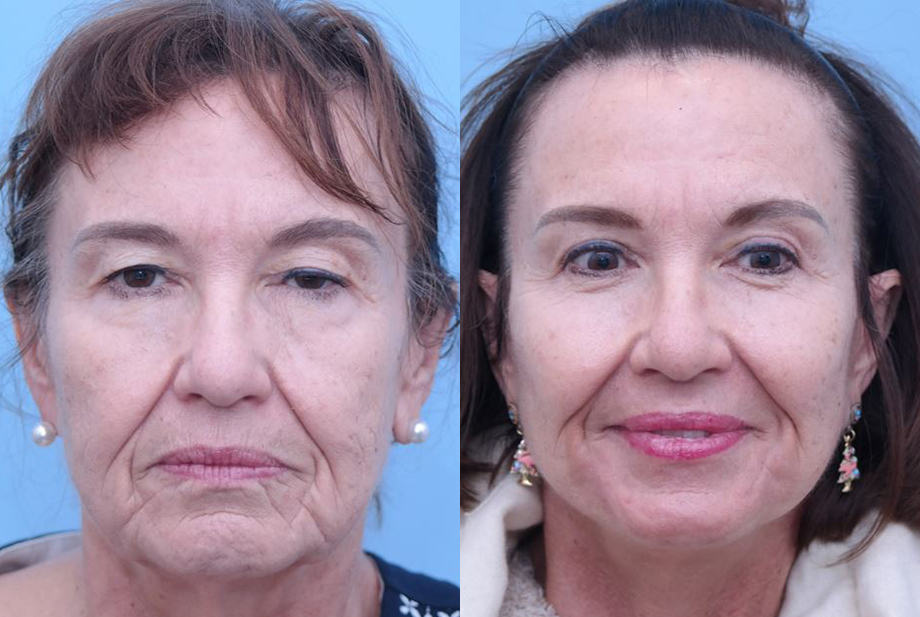 Facelift before and after photo by Midwest Facial Plastic Surgery in Minnesota