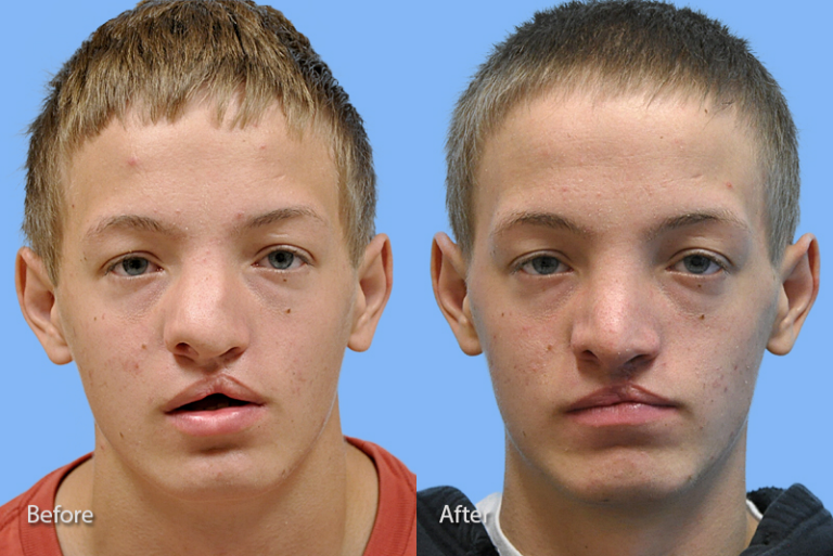 Cleft Lip Nose before and after photo by Midwest Facial Plastic Surgery in Minnesota