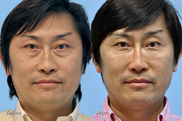 Before & After Galleries Midwest Facial Plastic Surgery