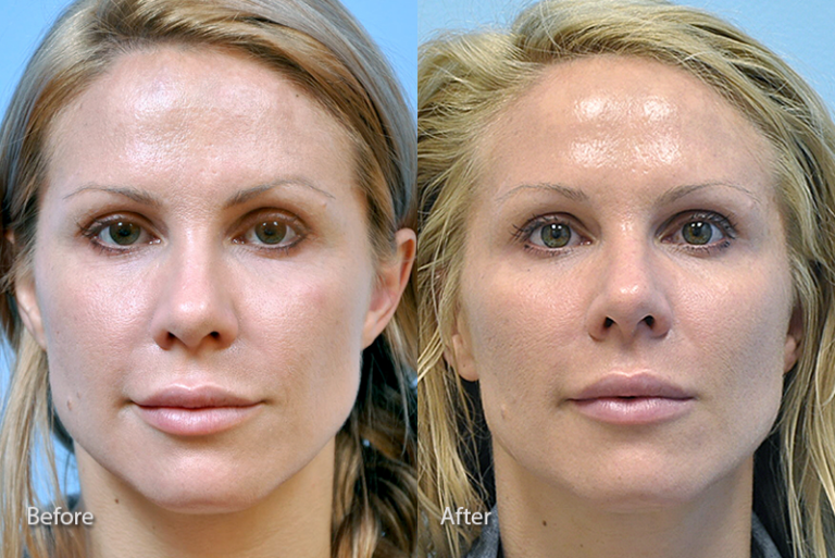 Before & After Galleries Midwest Facial Plastic Surgery