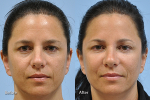 Injectable Fillers before and after photo by Midwest Facial Plastic Surgery in Minnesota