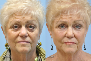 Injectable Fillers before and after photo by Midwest Facial Plastic Surgery in Minnesota