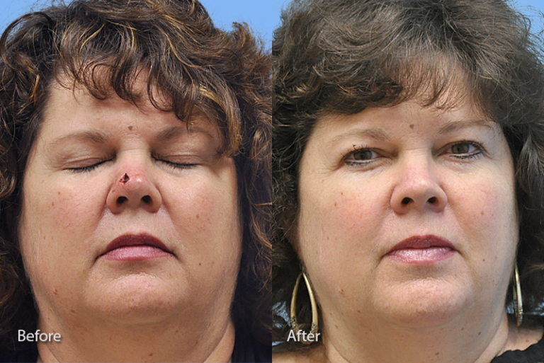 Mohs Reconstruction before and after photo by Midwest Facial Plastic Surgery in Minnesota