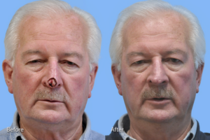 Mohs Reconstruction before and after photo by Midwest Facial Plastic Surgery in Minnesota