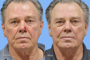 Mohs Reconstruction before and after photo by Midwest Facial Plastic Surgery in Minnesota