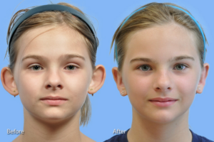 Otoplasty (Ear Reconstruction) before and after photo by Midwest Facial Plastic Surgery in Minnesota