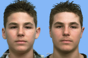 Otoplasty (Ear Reconstruction) before and after photo by Midwest Facial Plastic Surgery in Minnesota