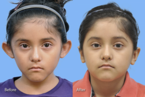 Otoplasty (Ear Reconstruction) before and after photo by Midwest Facial Plastic Surgery in Minnesota