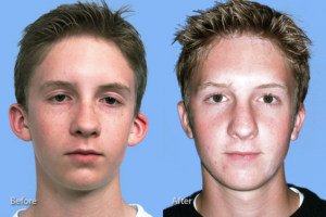 Otoplasty (Ear Reconstruction) before and after photo by Midwest Facial Plastic Surgery in Minnesota